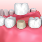An image of a crown placed onto a prepared tooth.